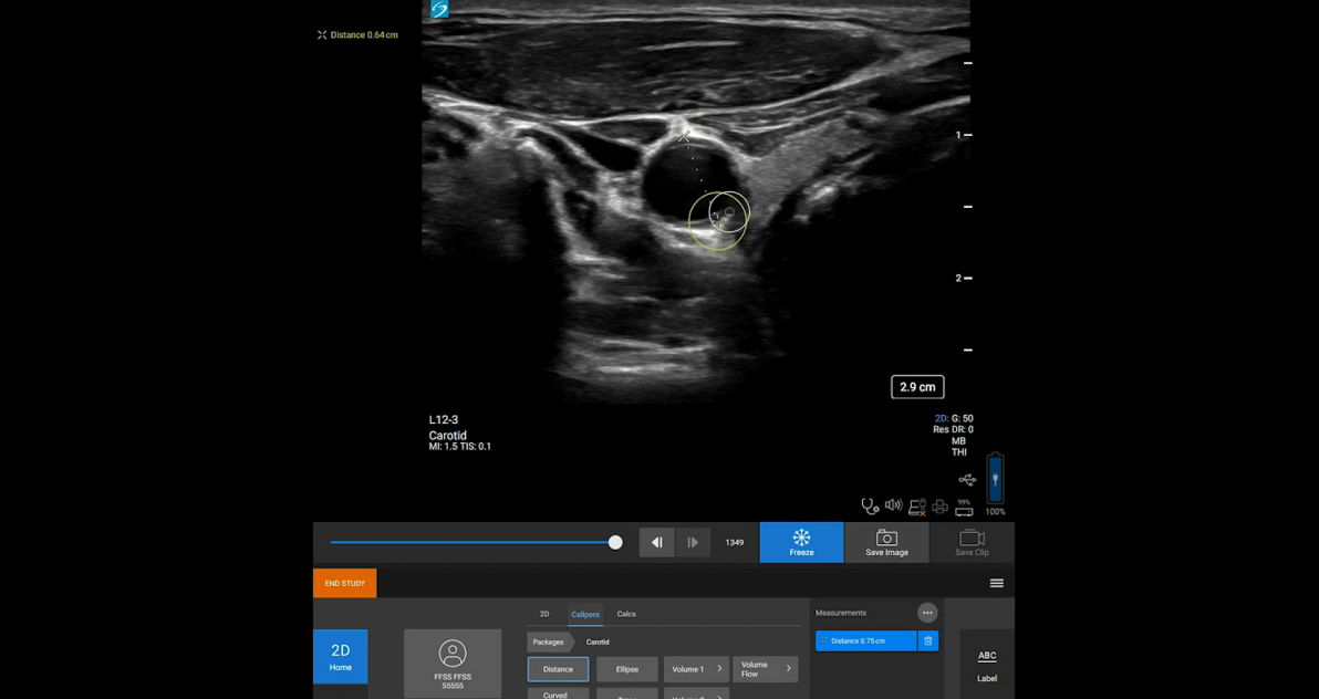 Sonosite ST taking measurement image