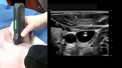 How to: Ultrasound Guided Internal Jugular Central Line