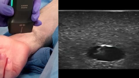  How to: Ultrasound Guided Radial Artery Access