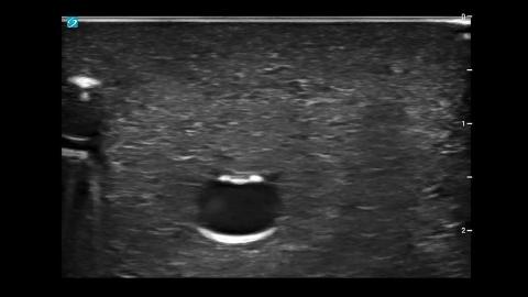 How to: Ultrasound Guided Subclavian Central Line
