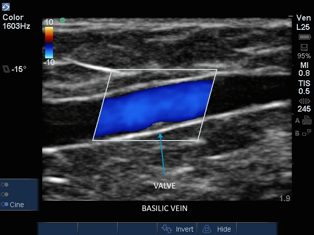 Vena basilica mit Klappe in Farbe