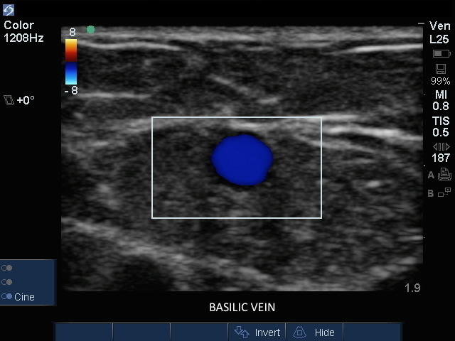 Vena basilica, transversal