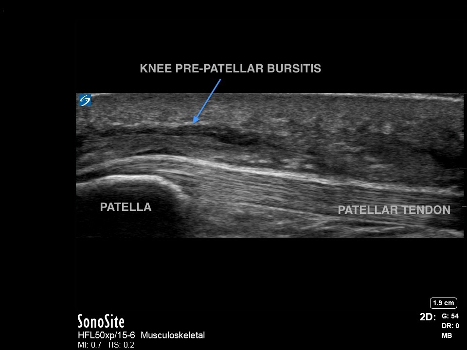 Knee: Prepatellar Bursitis