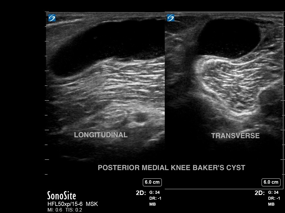 膝：ベーカー嚢胞画像