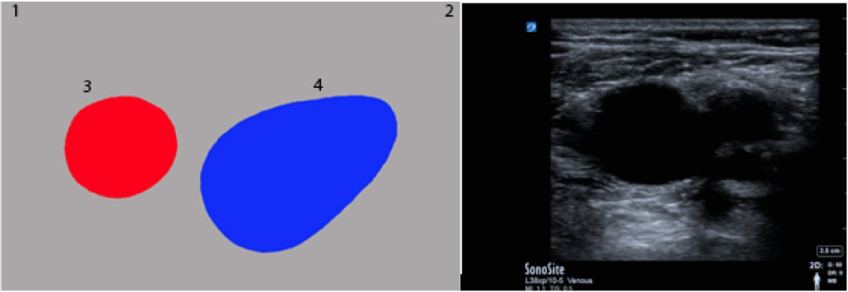 鼠径管内のCFV/CFA
