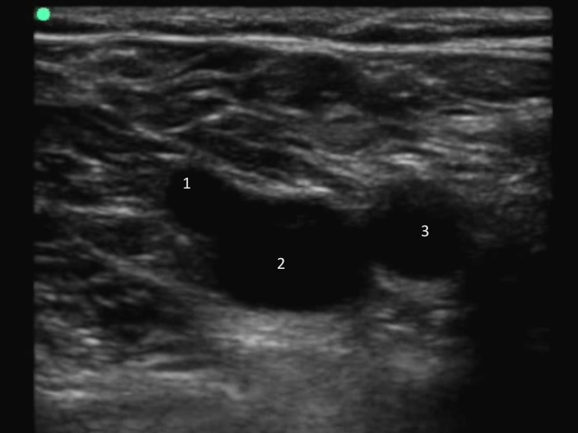 CFV Saph junct labeled