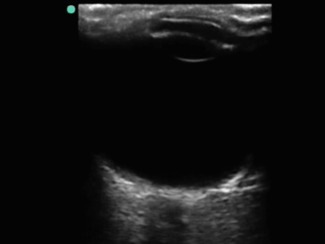 眼部视神经鞘 1