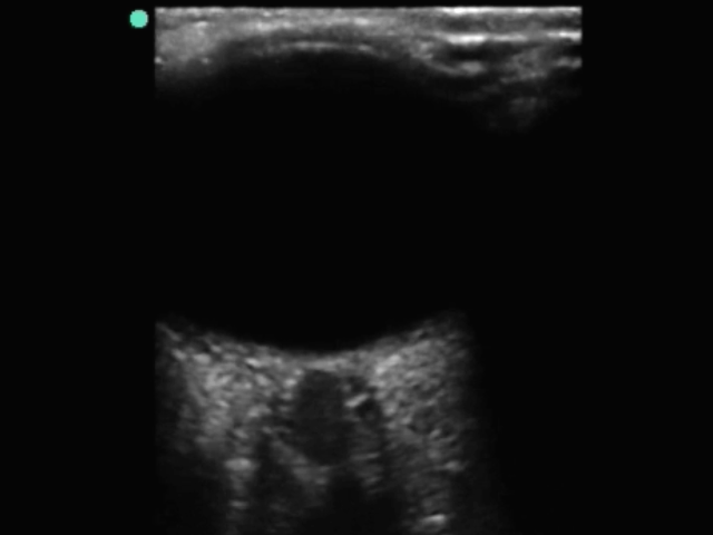 眼部视神经鞘 2
