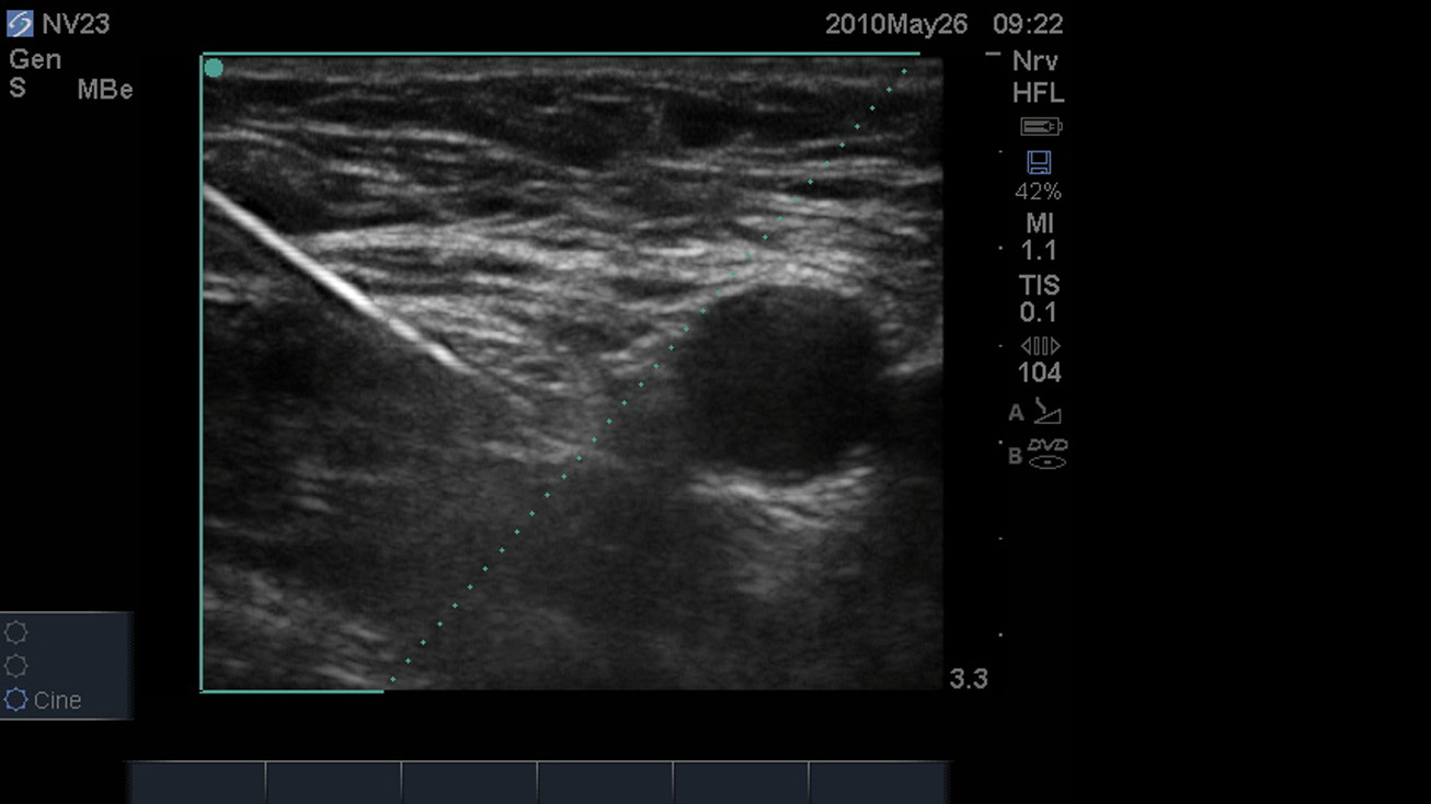 SonoMBe オン– 急大腿神経3cm