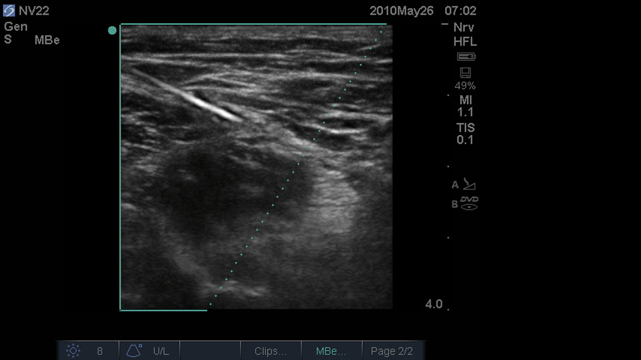 SonoMBe ein - steil, Nervus femoralis, 4 cm