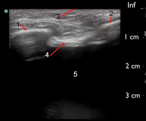 线性胸腔积液超声