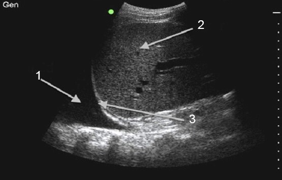 Thoracentesis Procedure