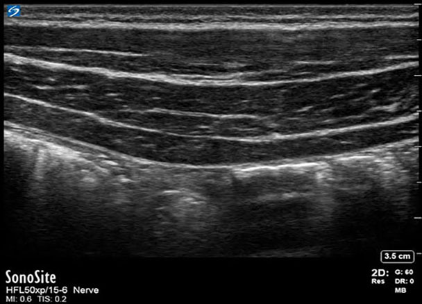 X-Porte: TAP-Nervenblockade