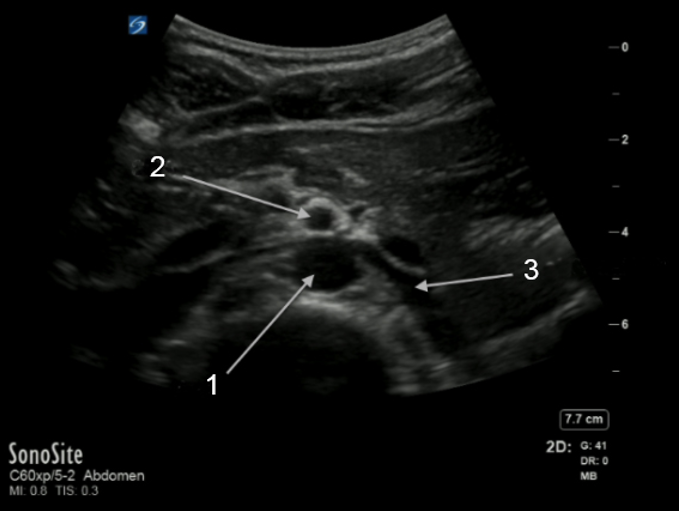 Aorta - Left Renal Vein Image